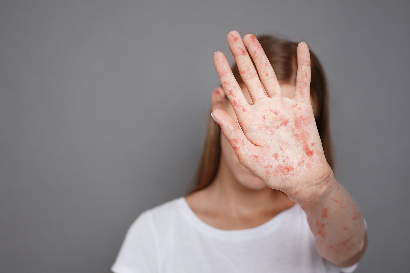Lonjakan Kasus Campak Measles di Kores Selatan