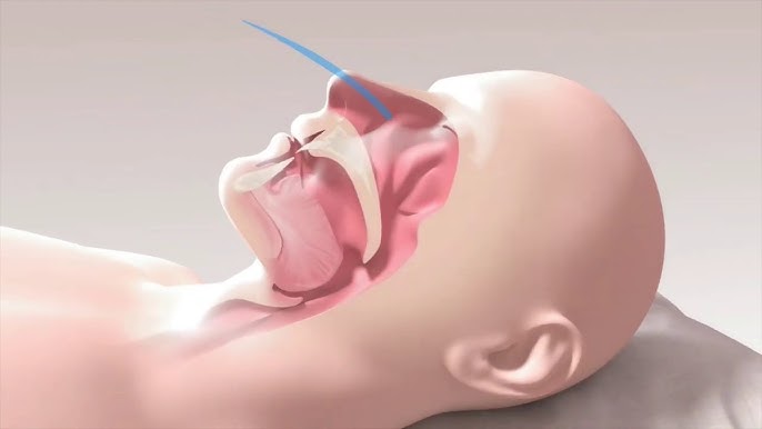 Bagaimana Menangani Sleep Apnea Secara Medis dan Gaya Hidup