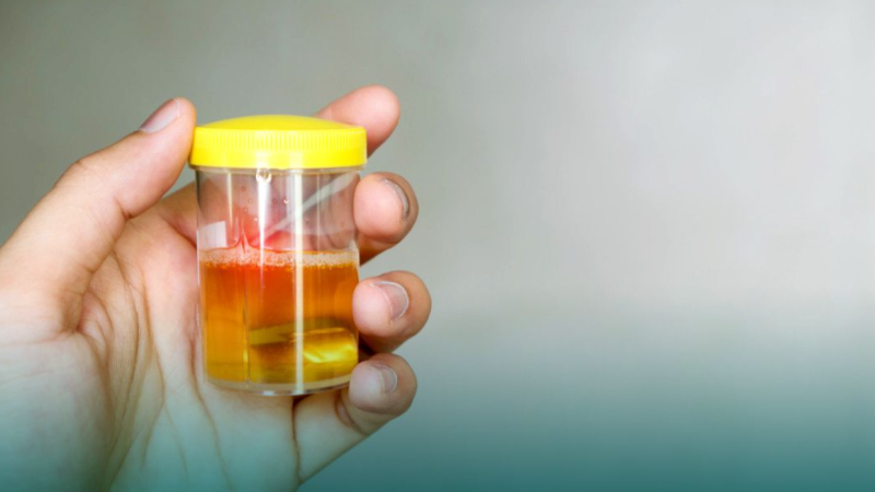 Jangan Anggap Sepele Urine Berbusa, Dokter Jelaskan Perbedaannya dengan Tanda Penyakit Ginjal