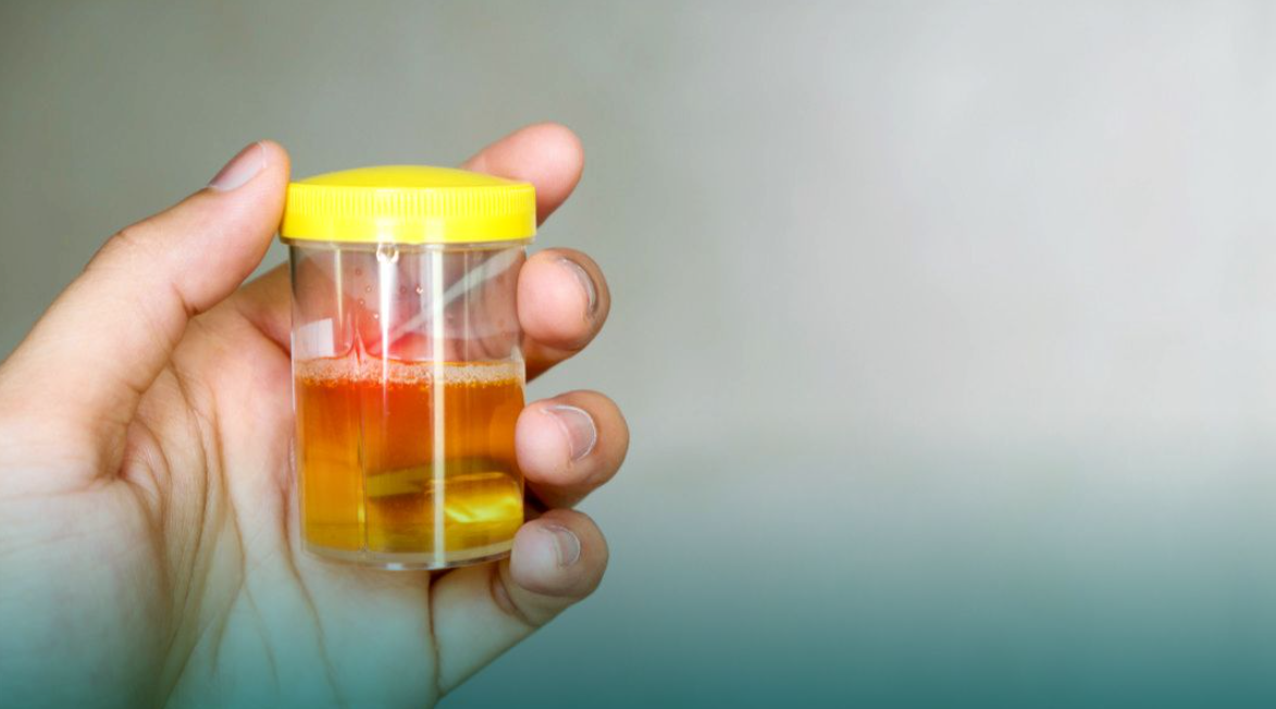 Jangan Anggap Sepele Urine Berbusa, Dokter Jelaskan Perbedaannya dengan Tanda Penyakit Ginjal