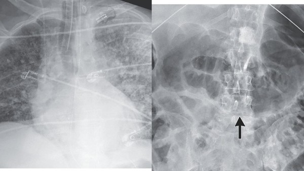 Merinding! 2 Pasien Terinfeksi Cacing Setelah Transplantasi Ginjal